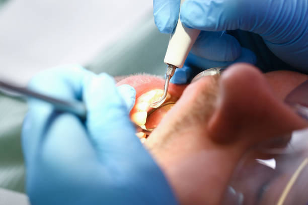 Best Chipped Tooth Repair Near Me  in Lake Catherine, IL
